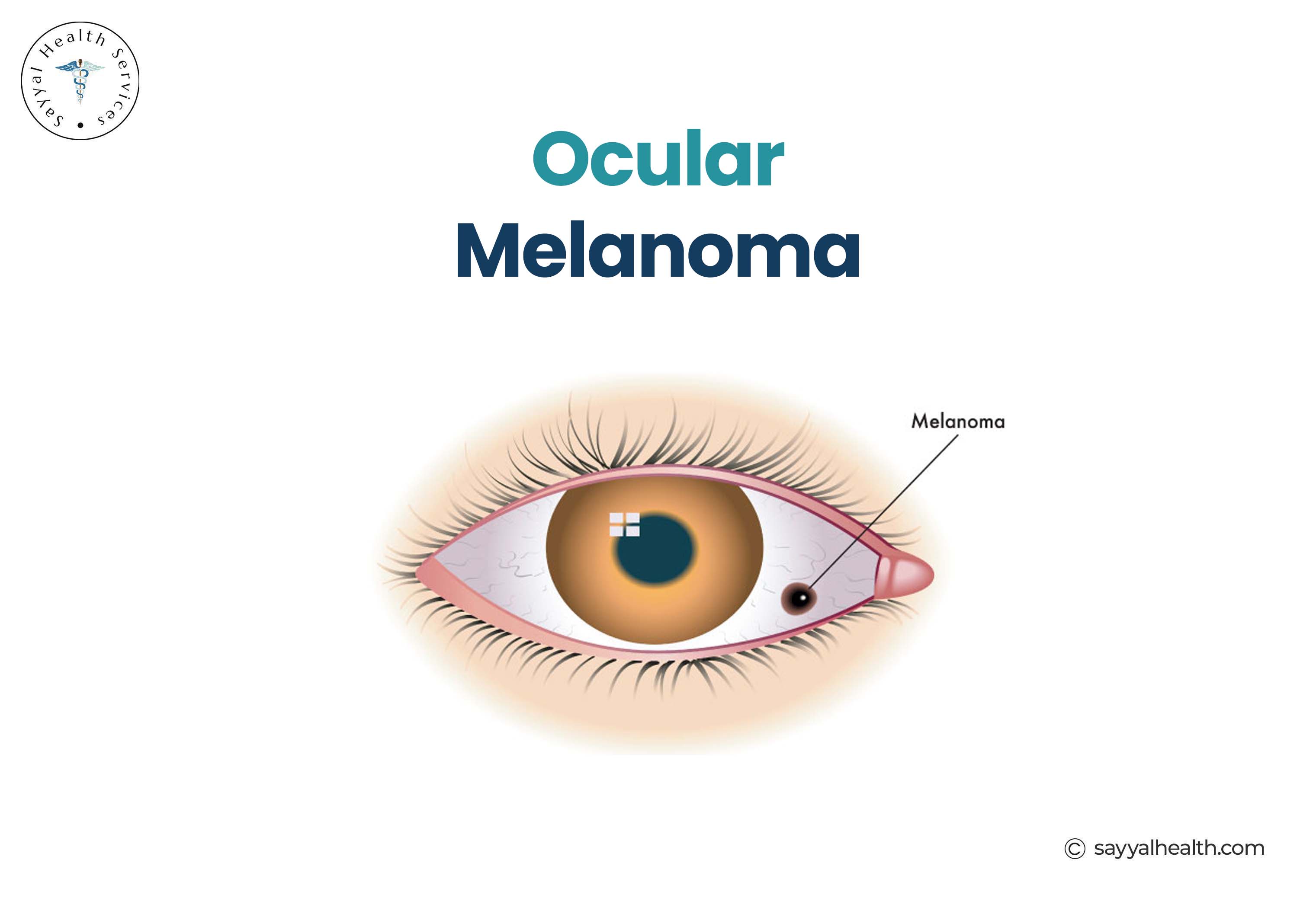Photos of Ocular Melanoma